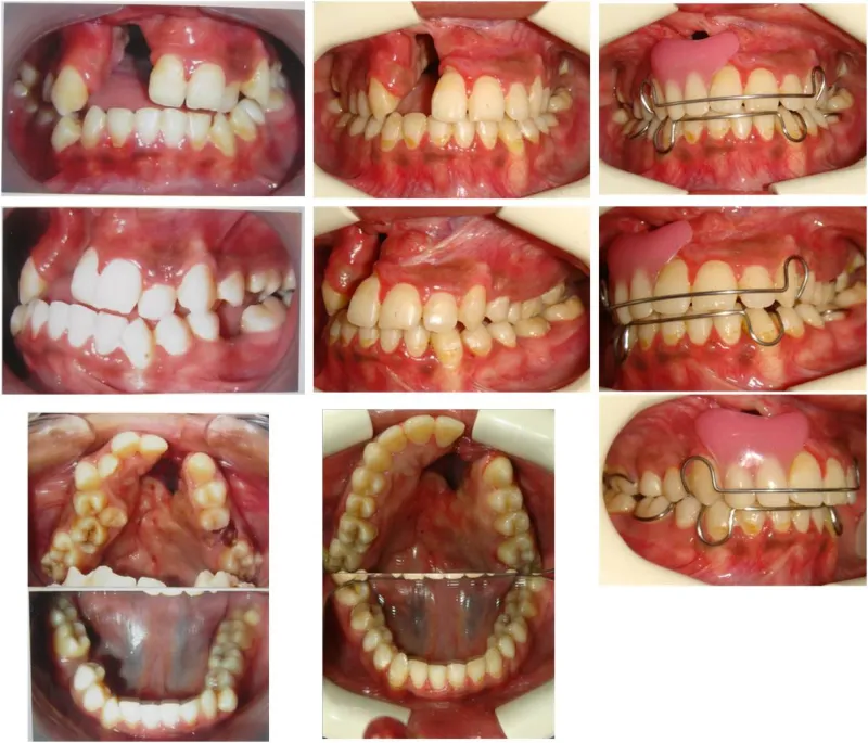 %20Cleft%20Lip%20&%20Cleft%20Palate