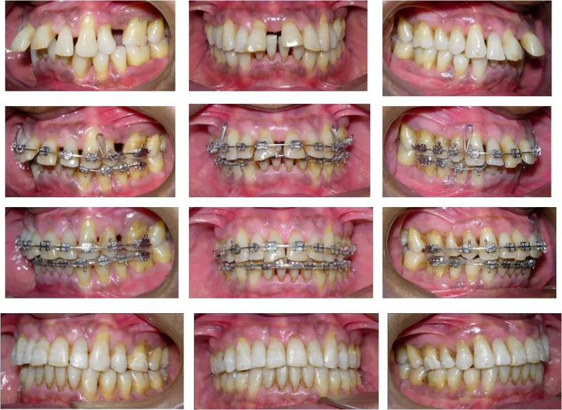%20Adult%20%20Orthodontics