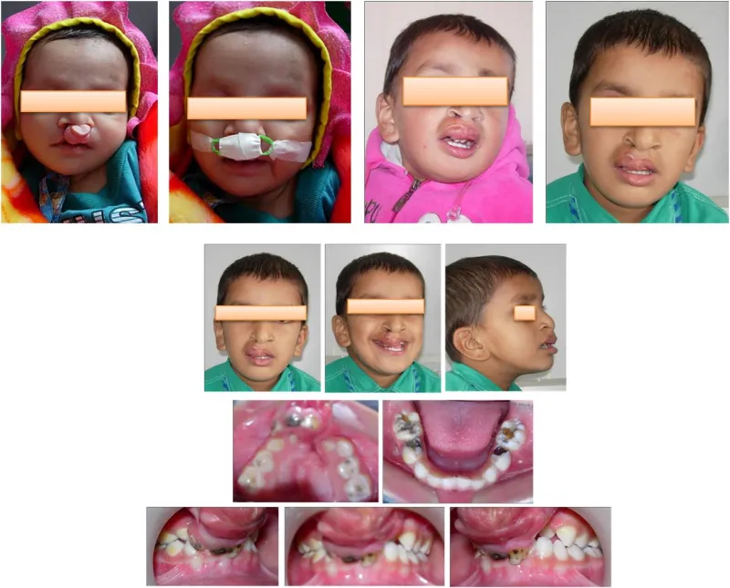 %20Cleft%20Lip%20&%20Cleft%20Palate