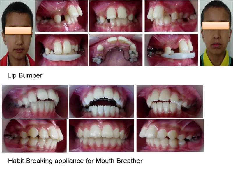 Interceptive%20Orthodontics